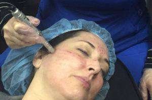 microneedling midland