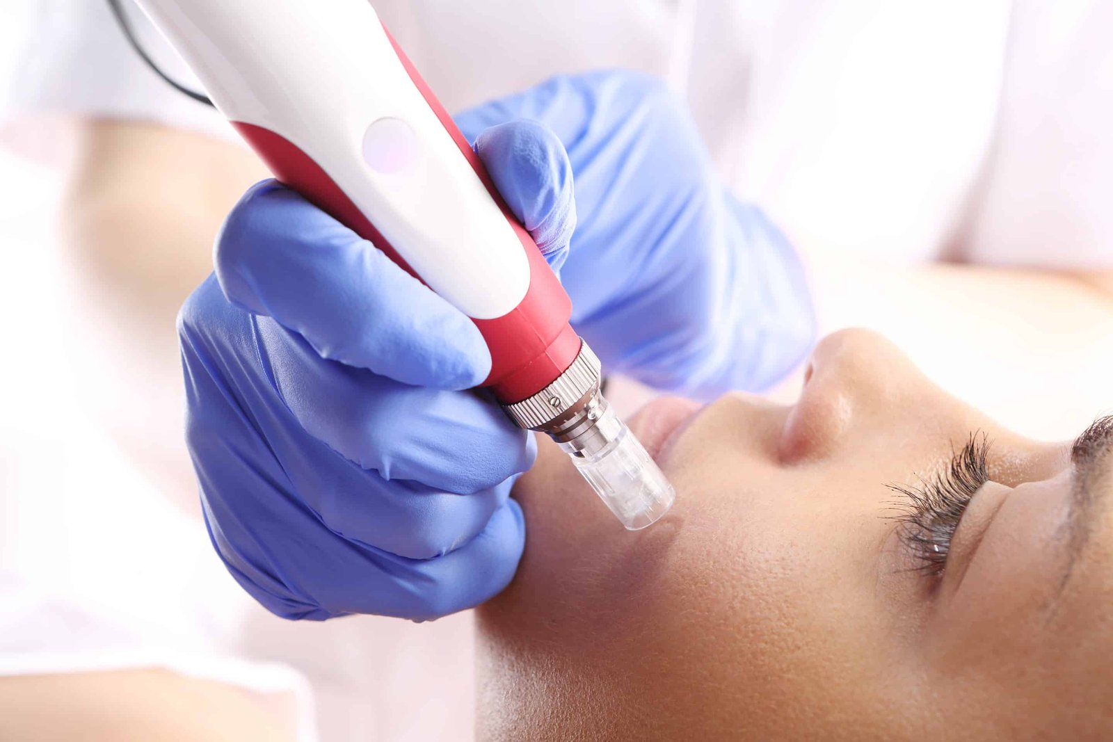 microneedling midland