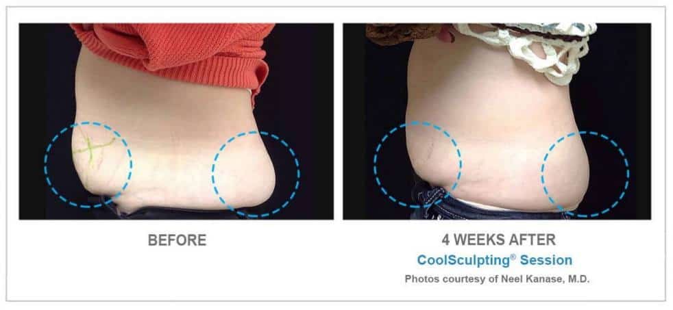 coolsculpting before after photos 5 10241